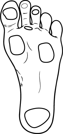 Мозолі